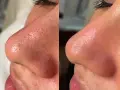 Antes y después de un Hydrafacial: la piel del rostro luce más limpia y luminosa, con poros menos visibles.