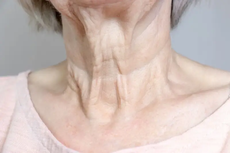 Primer plano del cuello flácido de una mujer mayor, mostrando arrugas y pliegues pronunciados.
