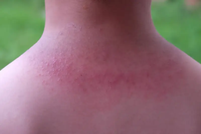 Sarpullido en el cuello, con piel enrojecida y pequeños bultos.