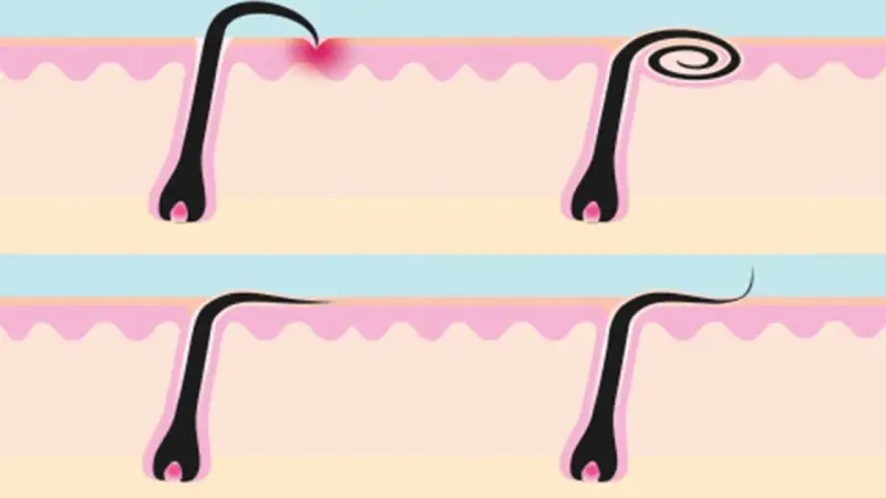 Ilustración de pelos enquistados en la piel, mostrando diferentes etapas de crecimiento y posible irritación.